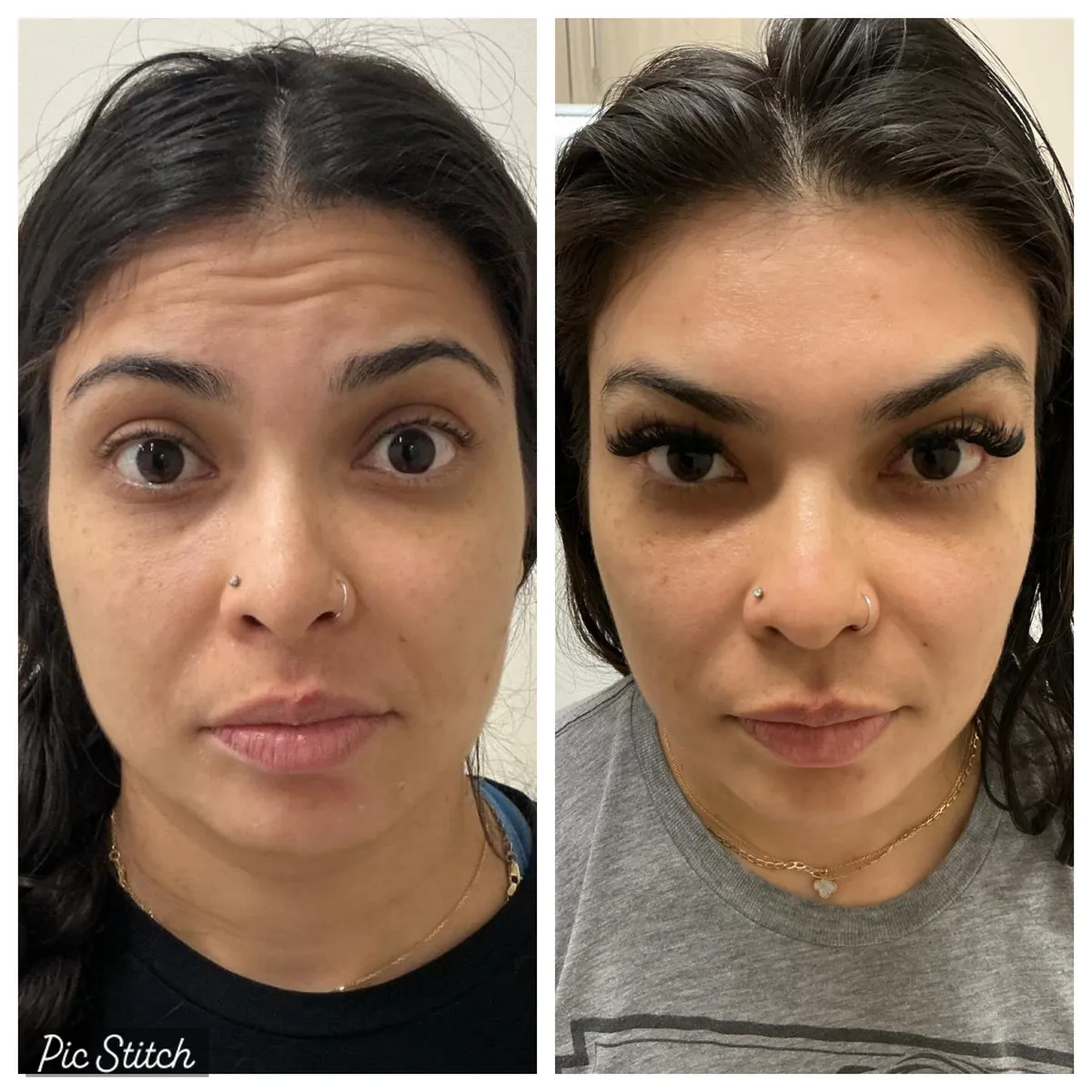 Before and after Botox Treatments results at Everis Aesthetic Medicine, patient photo 1