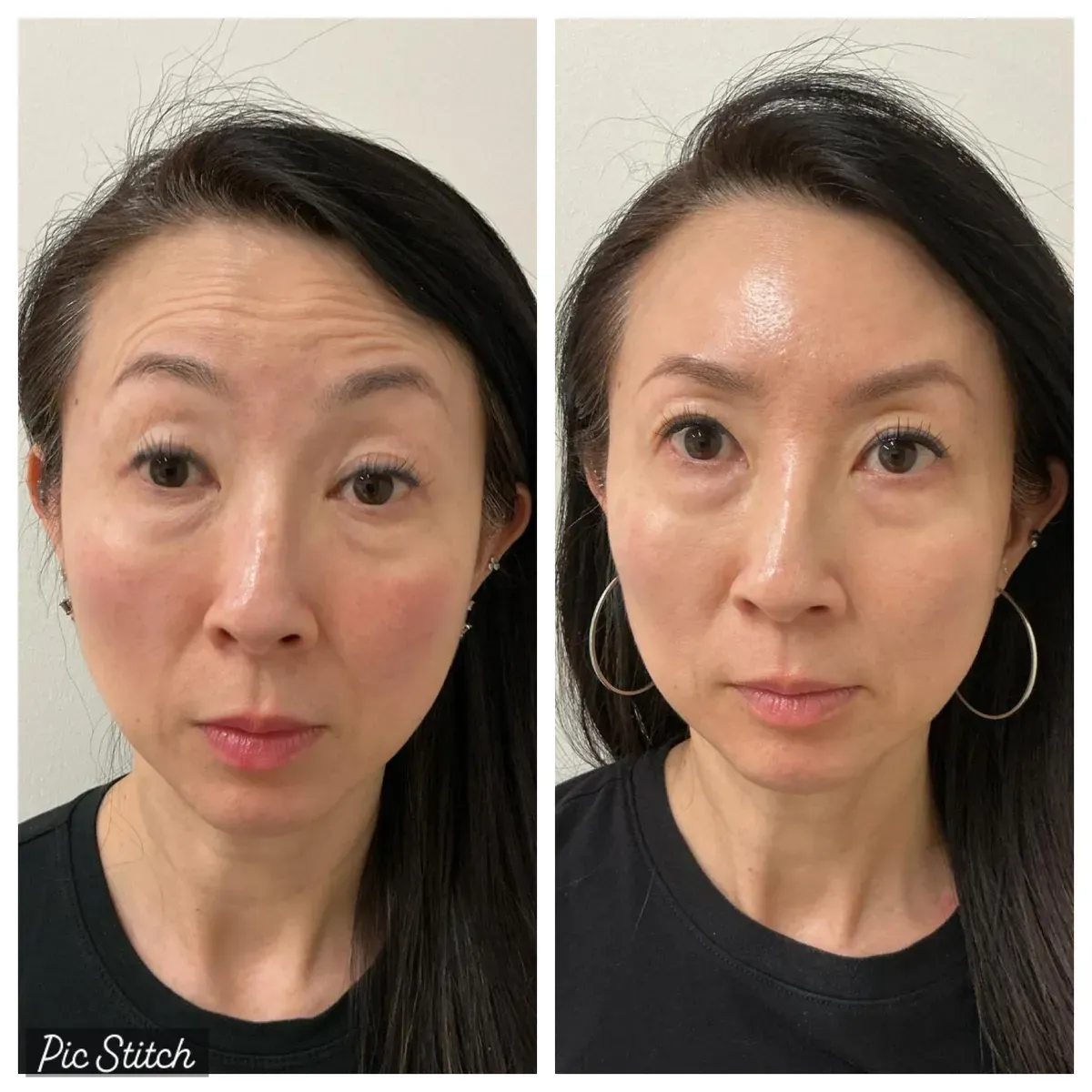 Before and after Botox Treatments results at Everis Aesthetic Medicine, patient photo 10