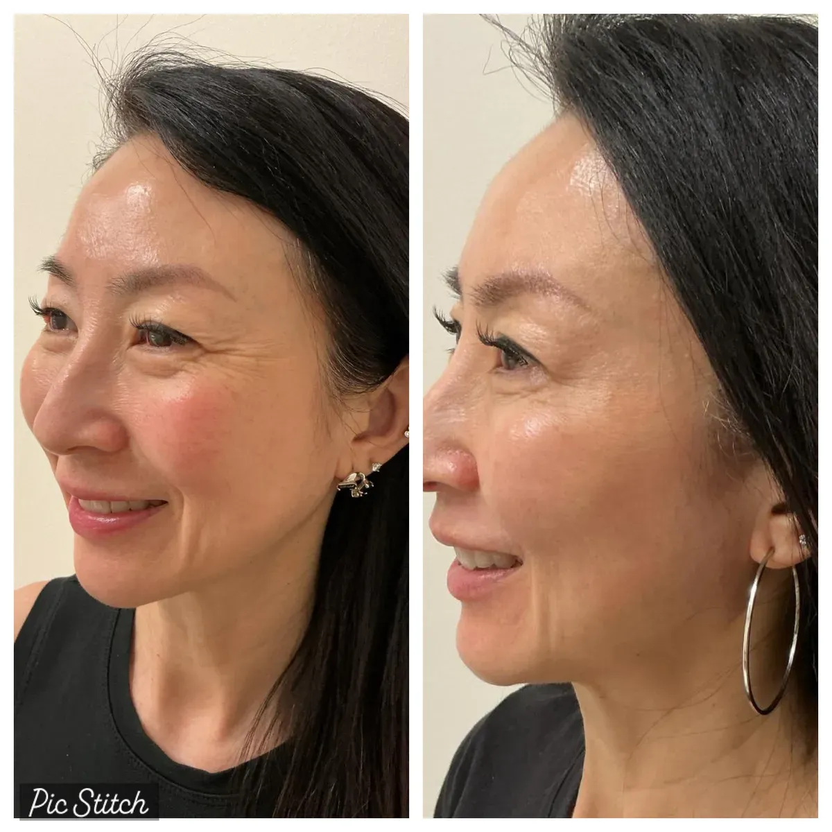 Before and after Botox Treatments results at Everis Aesthetic Medicine, patient photo 11