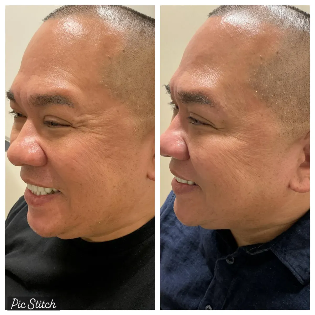 Before and after Botox Treatments results at Everis Aesthetic Medicine, patient photo 12