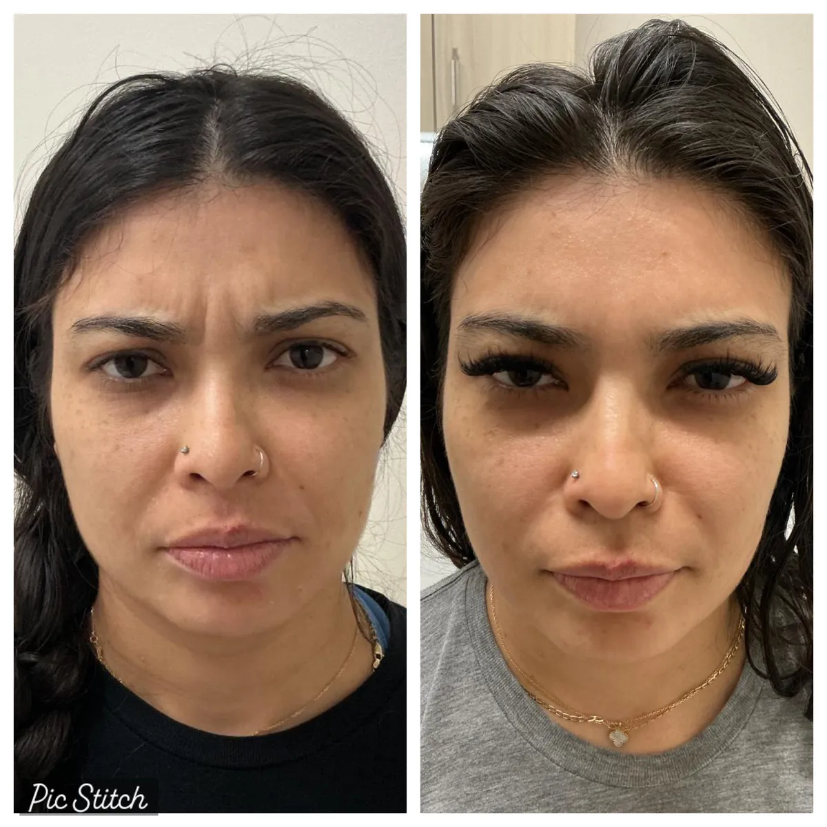 Before and after Botox Treatments results at Everis Aesthetic Medicine, patient photo 2