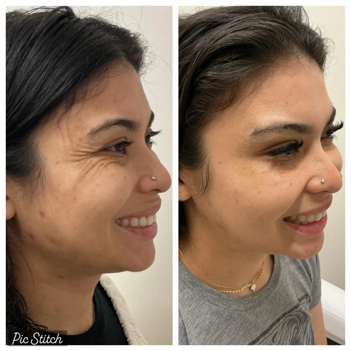 Before and after Botox Treatments results at Everis Aesthetic Medicine, patient photo 3