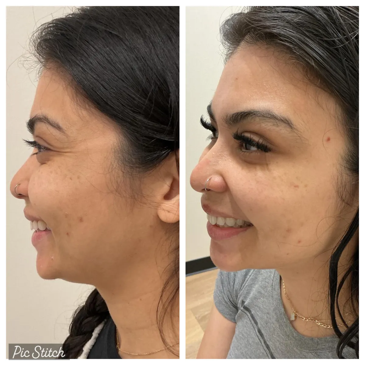Before and after Botox Treatments results at Everis Aesthetic Medicine, patient photo 4