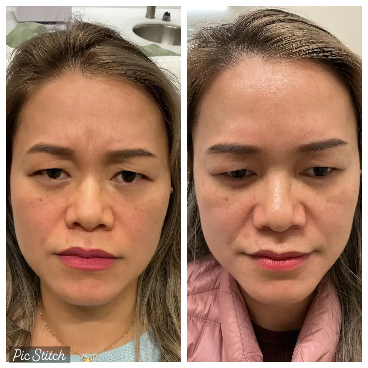 Before and after Botox Treatments results at Everis Aesthetic Medicine, patient photo 5