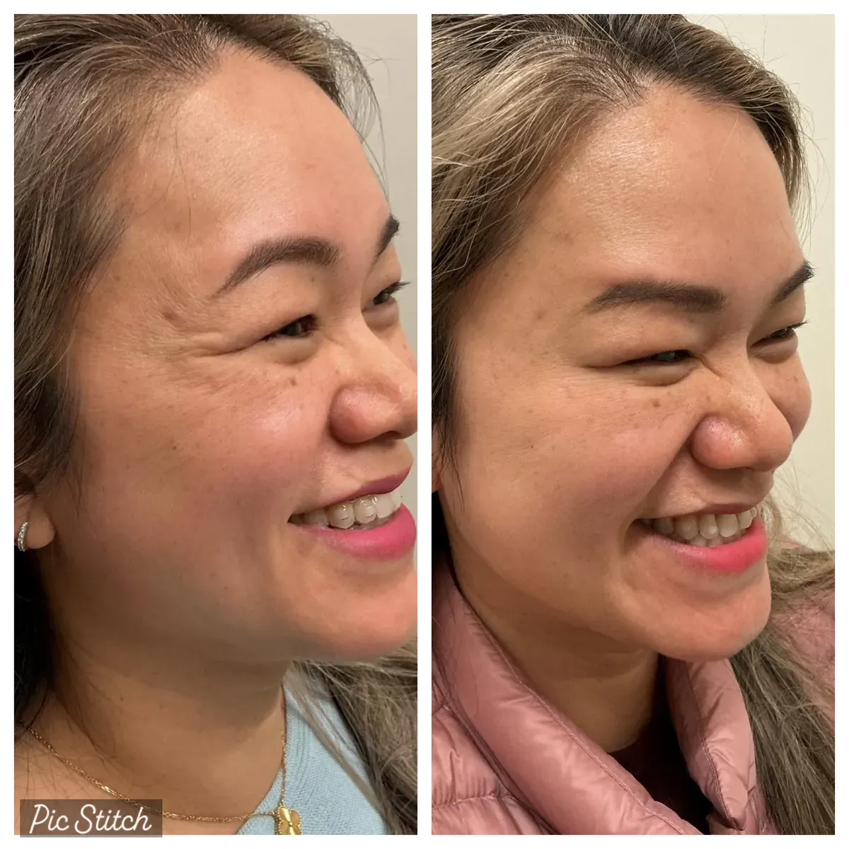 Before and after Botox Treatments results at Everis Aesthetic Medicine, patient photo 6
