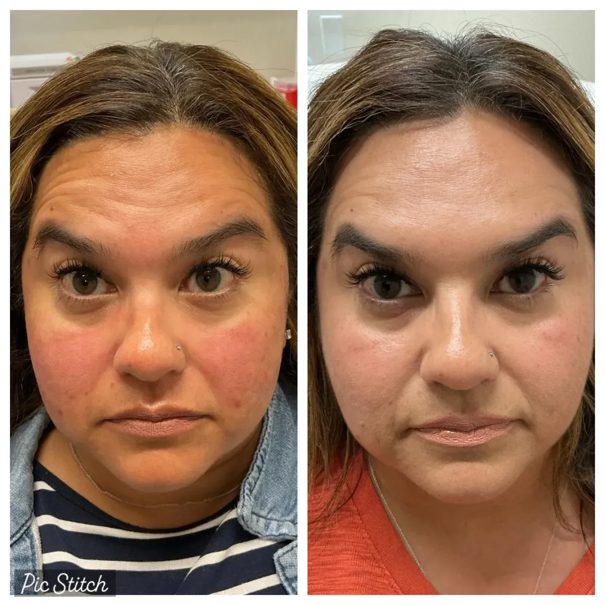 Before and after Botox Treatments results at Everis Aesthetic Medicine, patient photo 7