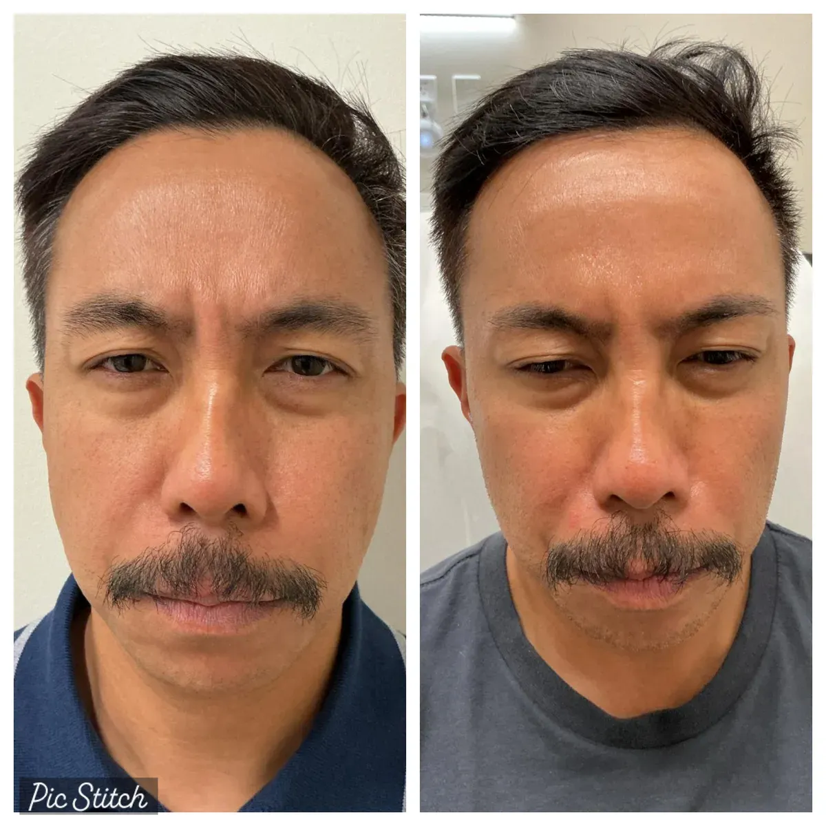 Before and after Botox Treatments results at Everis Aesthetic Medicine, patient photo 8
