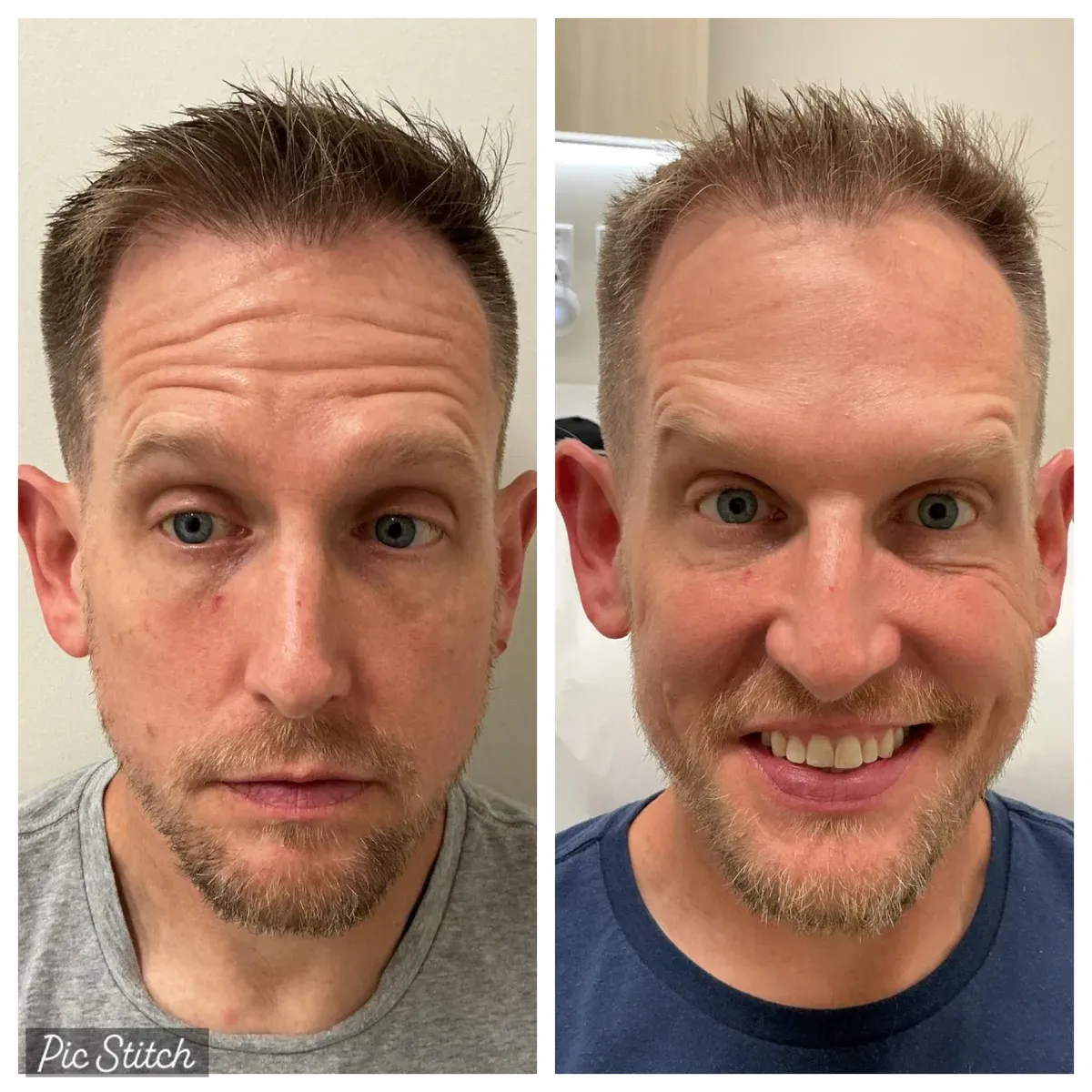 Before and after Botox Treatments results at Everis Aesthetic Medicine, patient photo 9