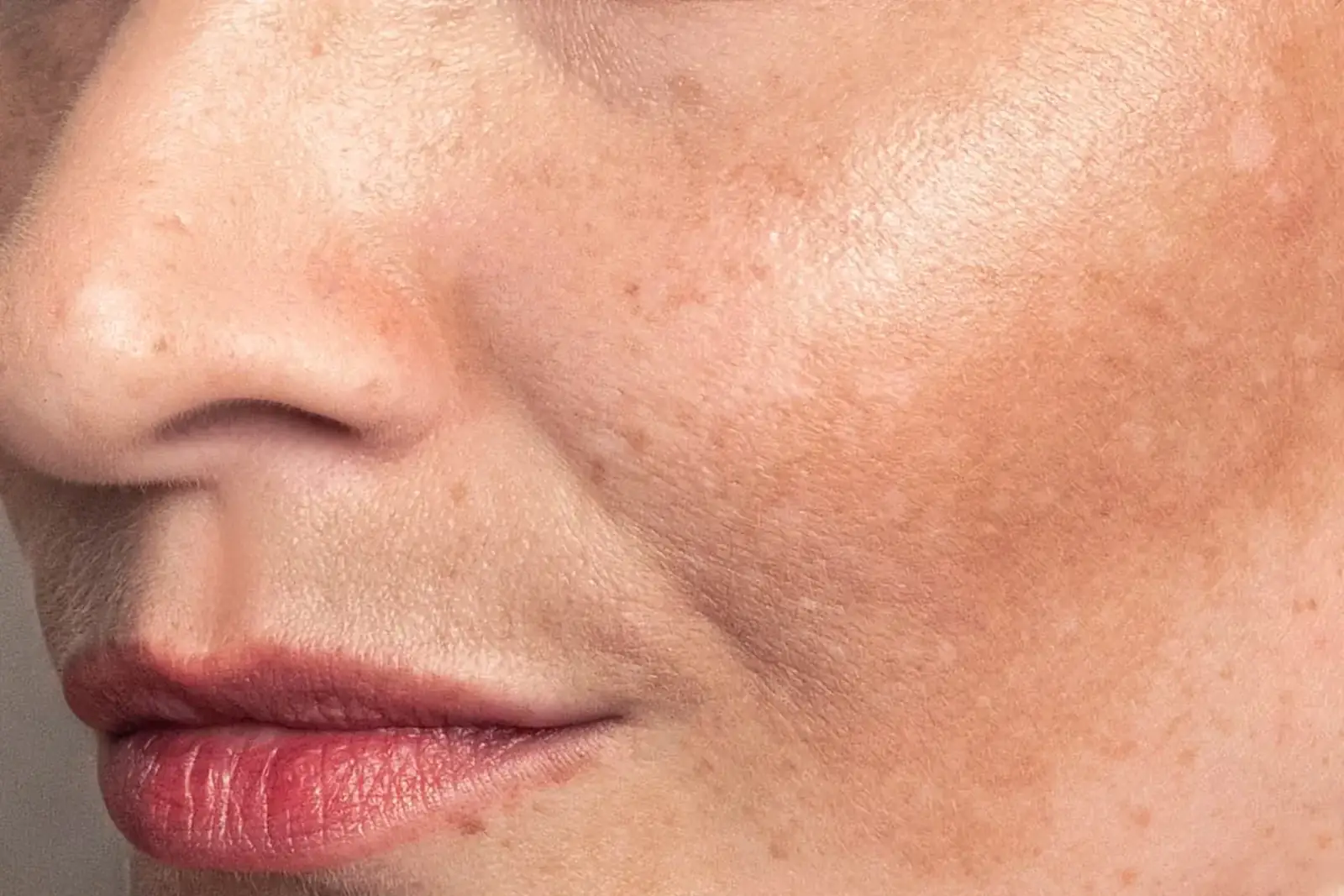Laser Sun Spot and Melasma Removal treatment at Everis Aesthetic Medicine in Milpitas, CA