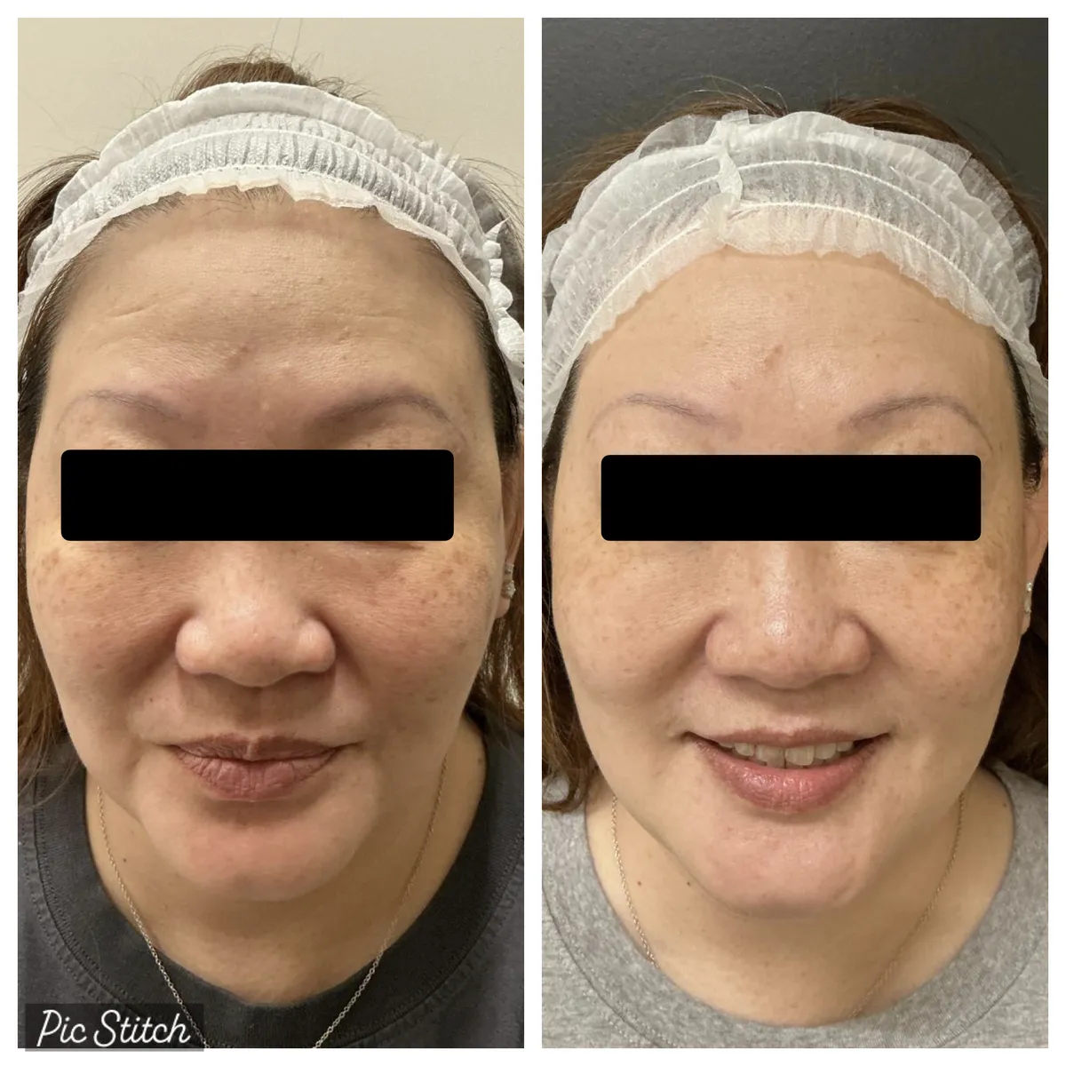 Before and after Sciton BBL HEROic results at Everis Aesthetic Medicine, patient photo 1