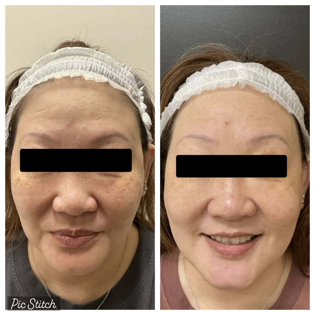 Before and after Sciton BBL HEROic results at Everis Aesthetic Medicine, patient photo 10