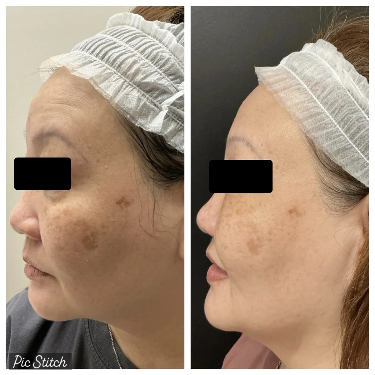 Before and after Sciton BBL HEROic results at Everis Aesthetic Medicine, patient photo 11
