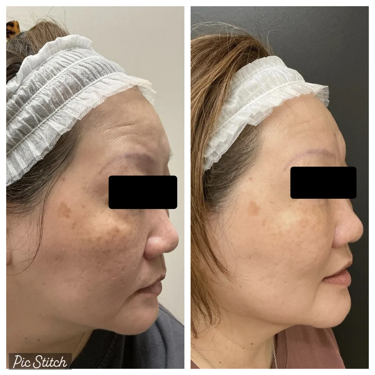 Before and after Sciton BBL HEROic results at Everis Aesthetic Medicine, patient photo 12