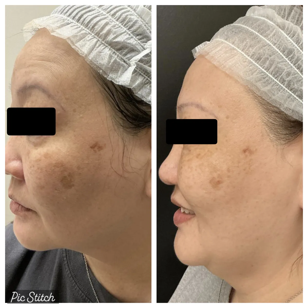 Before and after Sciton BBL HEROic results at Everis Aesthetic Medicine, patient photo 2