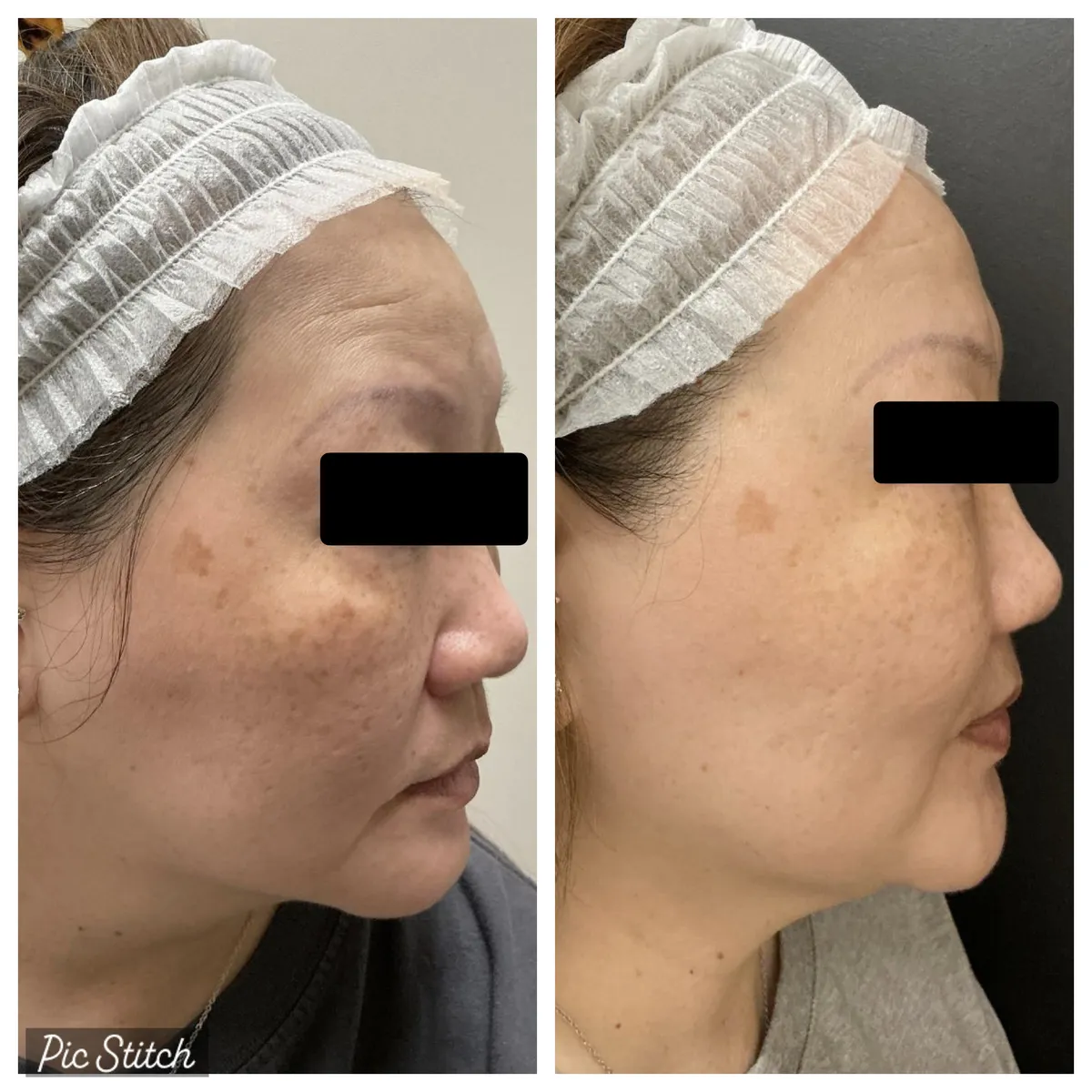 Before and after Sciton BBL HEROic results at Everis Aesthetic Medicine, patient photo 3