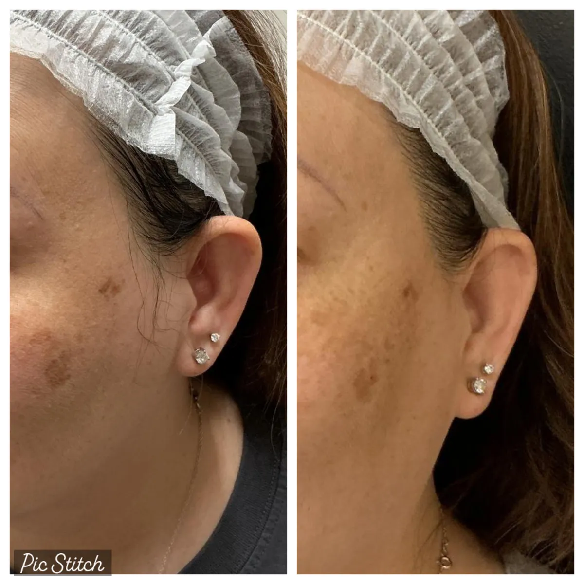 Before and after Sciton BBL HEROic results at Everis Aesthetic Medicine, patient photo 4