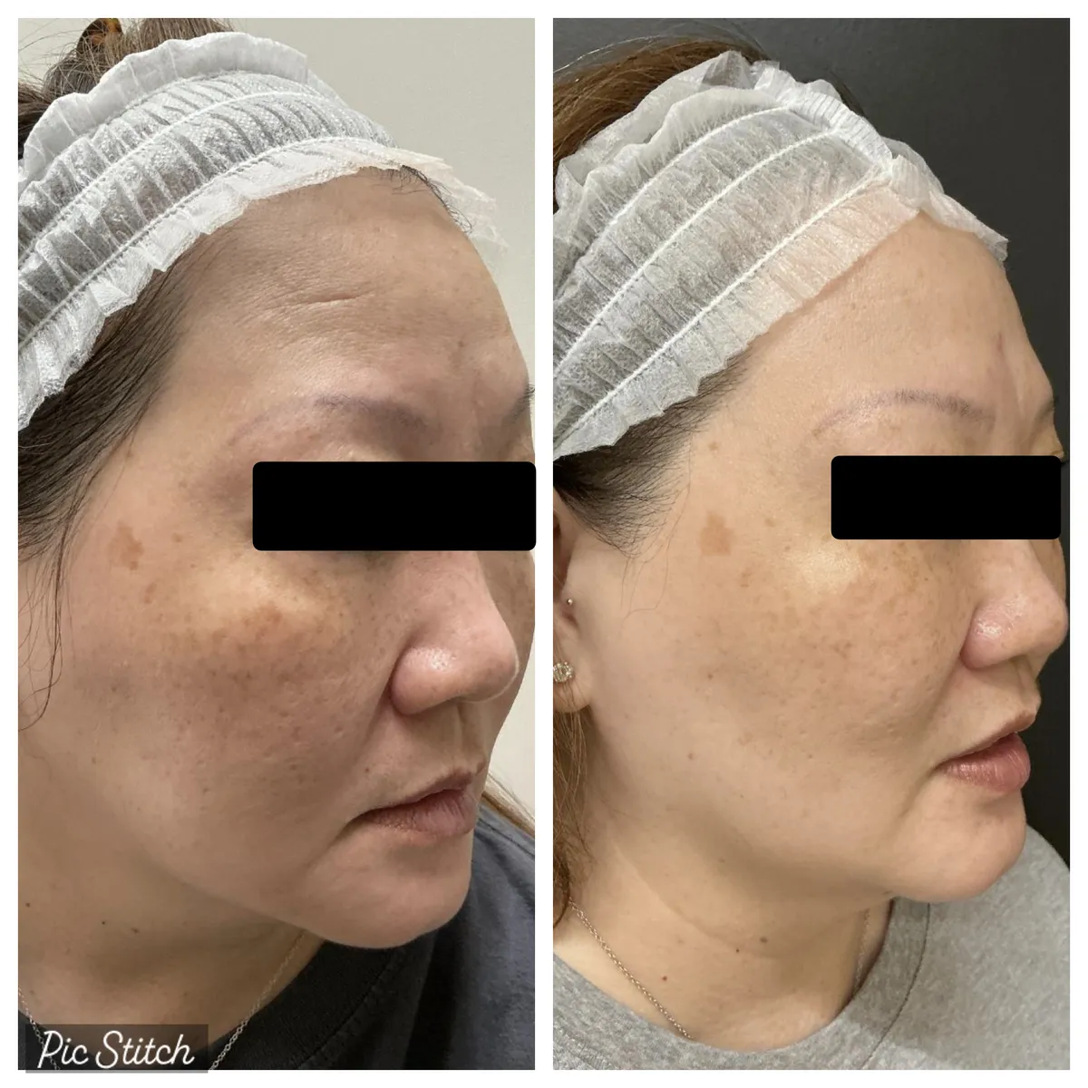 Before and after Sciton BBL HEROic results at Everis Aesthetic Medicine, patient photo 5