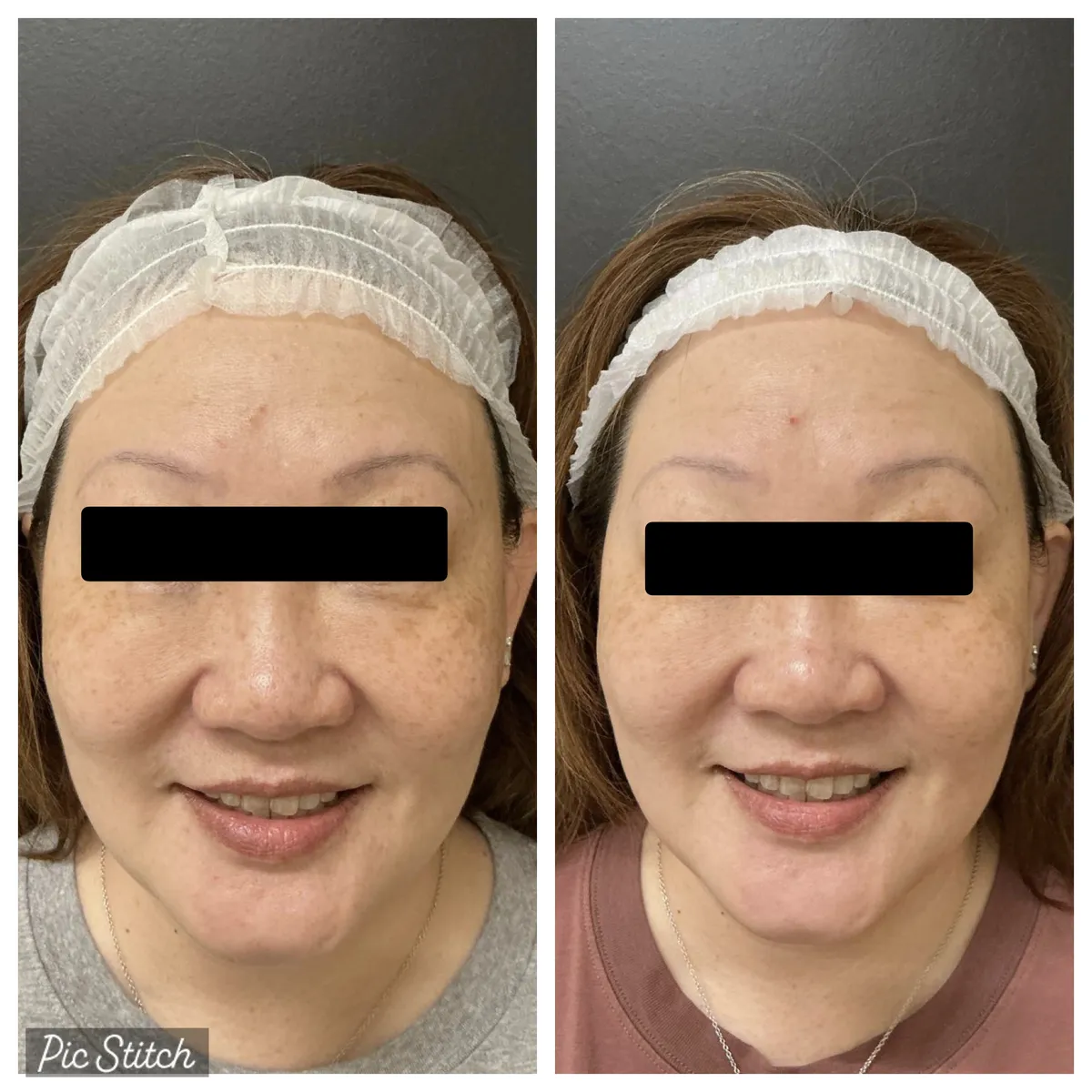 Before and after Sciton BBL HEROic results at Everis Aesthetic Medicine, patient photo 6