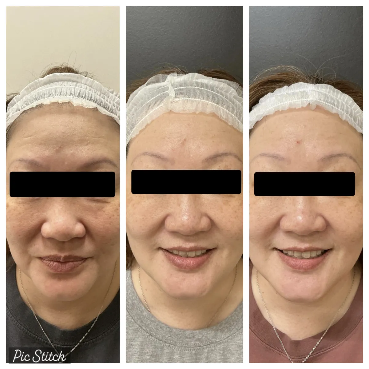 Before and after Sciton BBL HEROic results at Everis Aesthetic Medicine, patient photo 7
