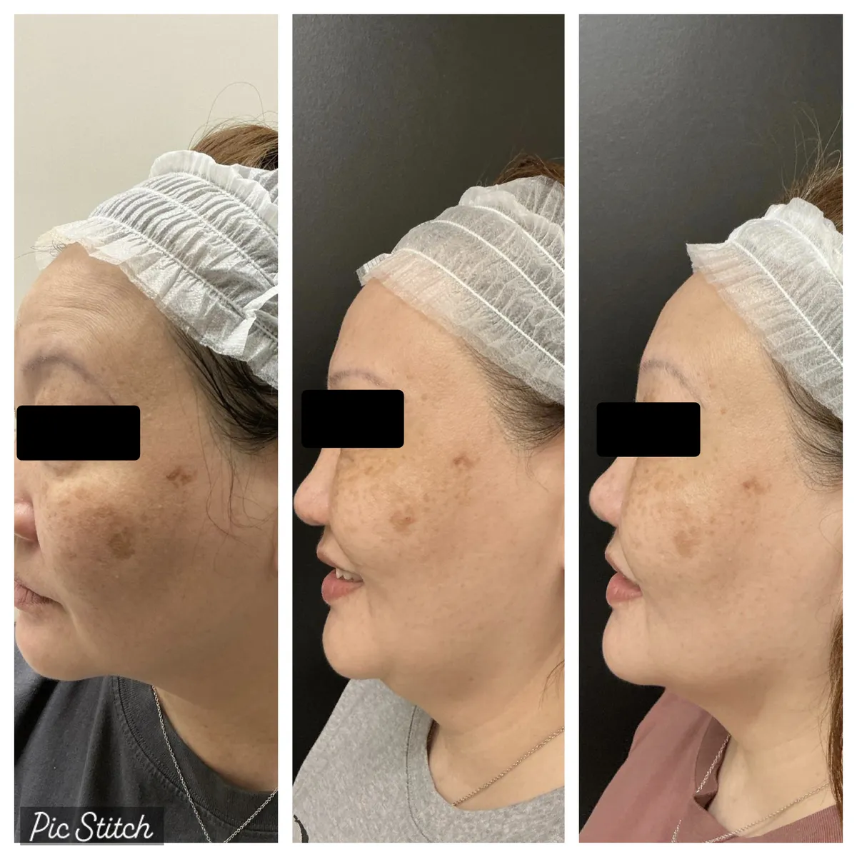Before and after Sciton BBL HEROic results at Everis Aesthetic Medicine, patient photo 8