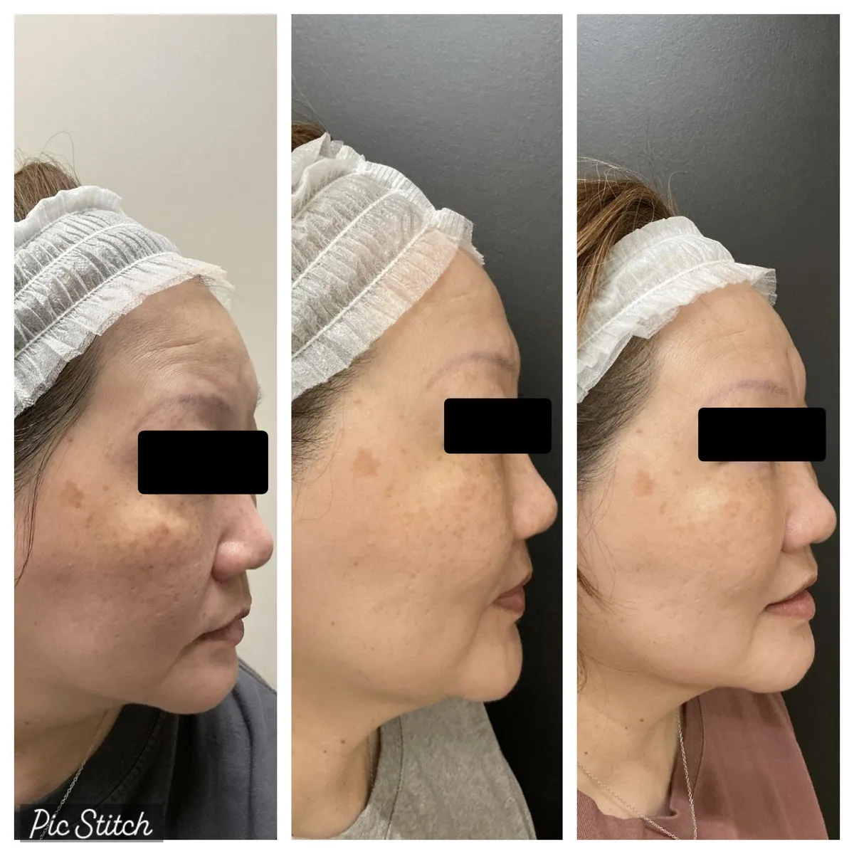 Before and after Sciton BBL HEROic results at Everis Aesthetic Medicine, patient photo 9