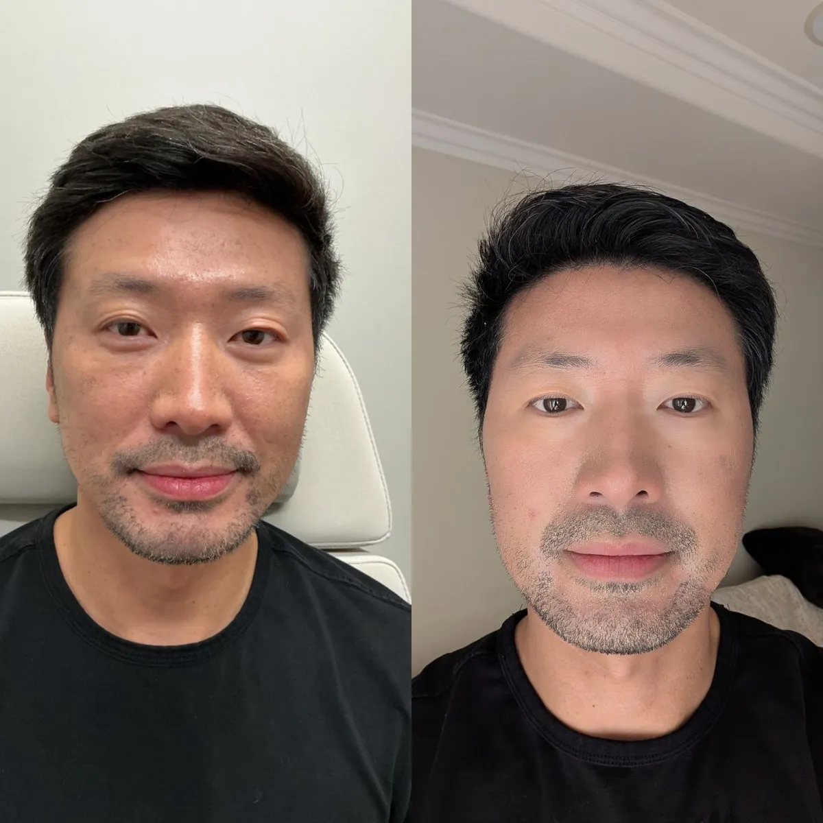 Before and after MOXI results at Everis Aesthetic Medicine, patient photo 1
